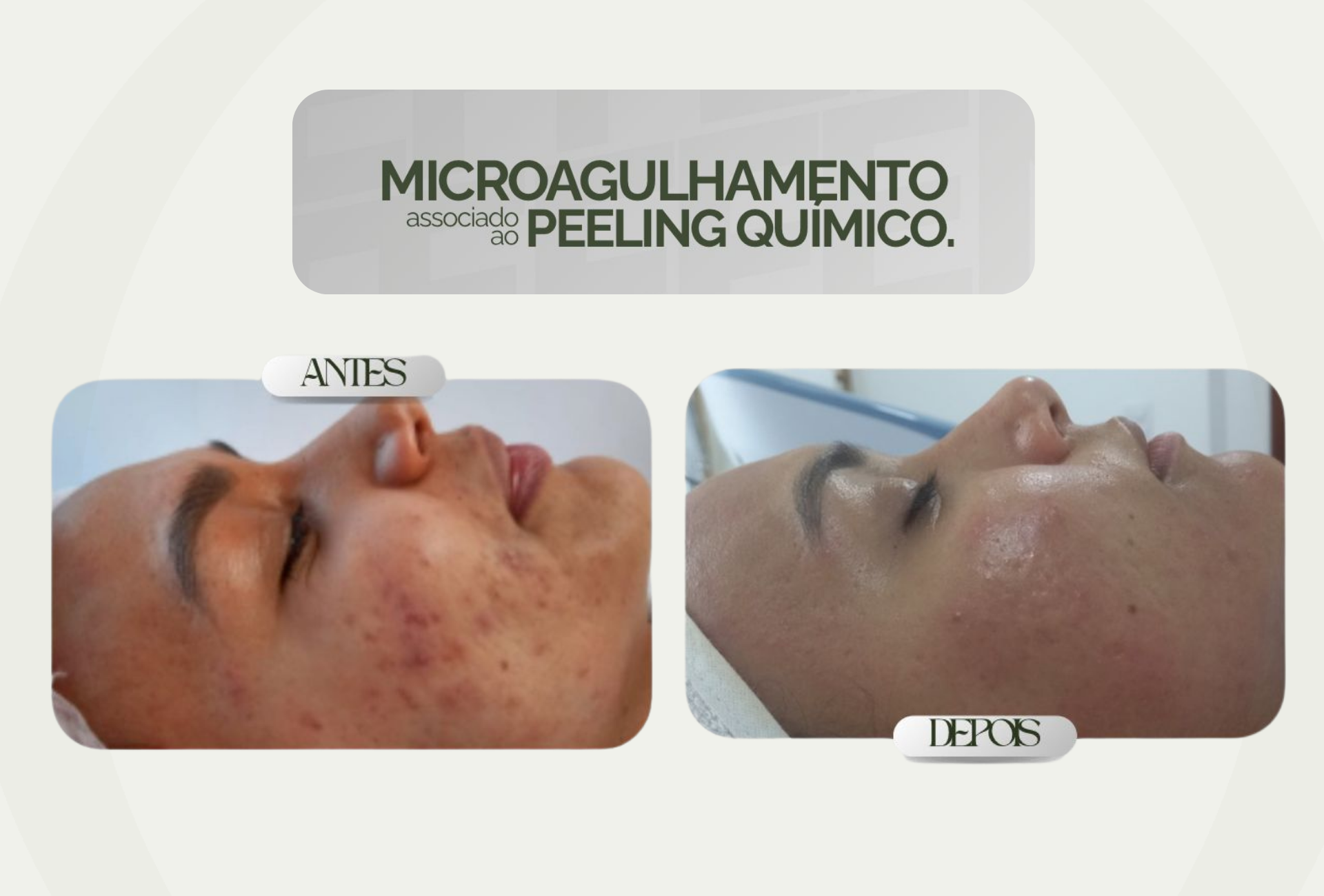 Microagulhamento com Peeling Químico em Florianópolis: vale a pena combinar os tratamentos?